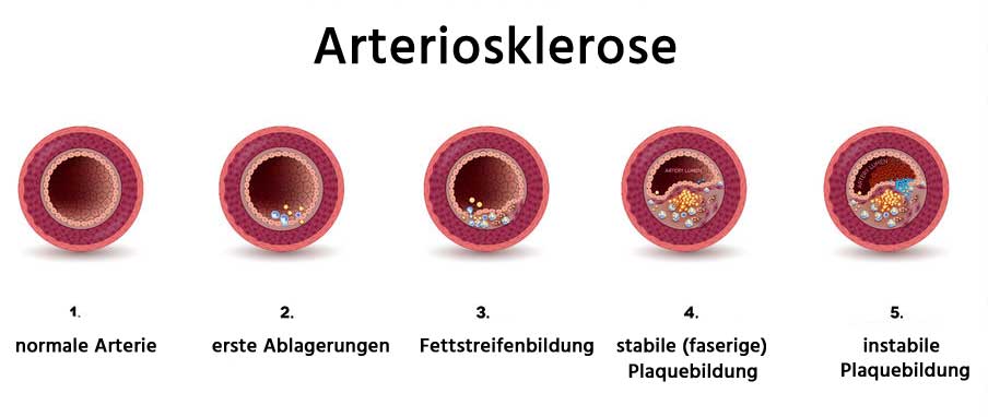 ᐅ Was Ist Arteriosklerose (Arterienverkalkung)? Symptome, Warnsignale